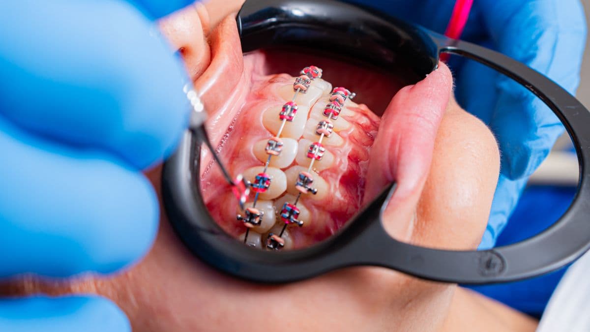 Close-up of traditional metal braces during orthodontic treatment